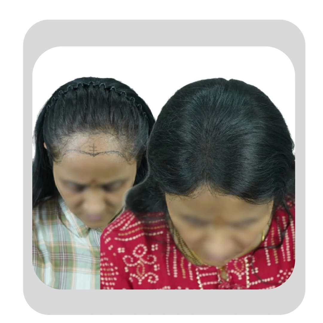 Before and after of a female hairline transplant in Pune showing surgical hairline design and dense, fully restored hair growth.
