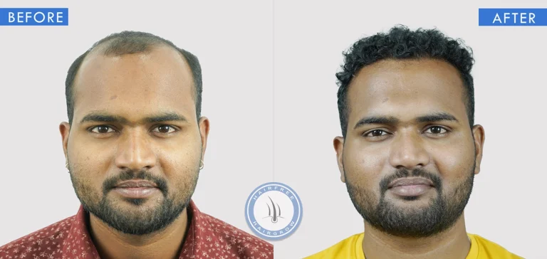 Hair transplant before and after transformation by leading hair transplant surgeon in Pune