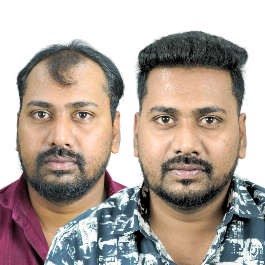 Hair Transplant Result in Pune- Dr Kiran Chotaliya at Pimple Gurav