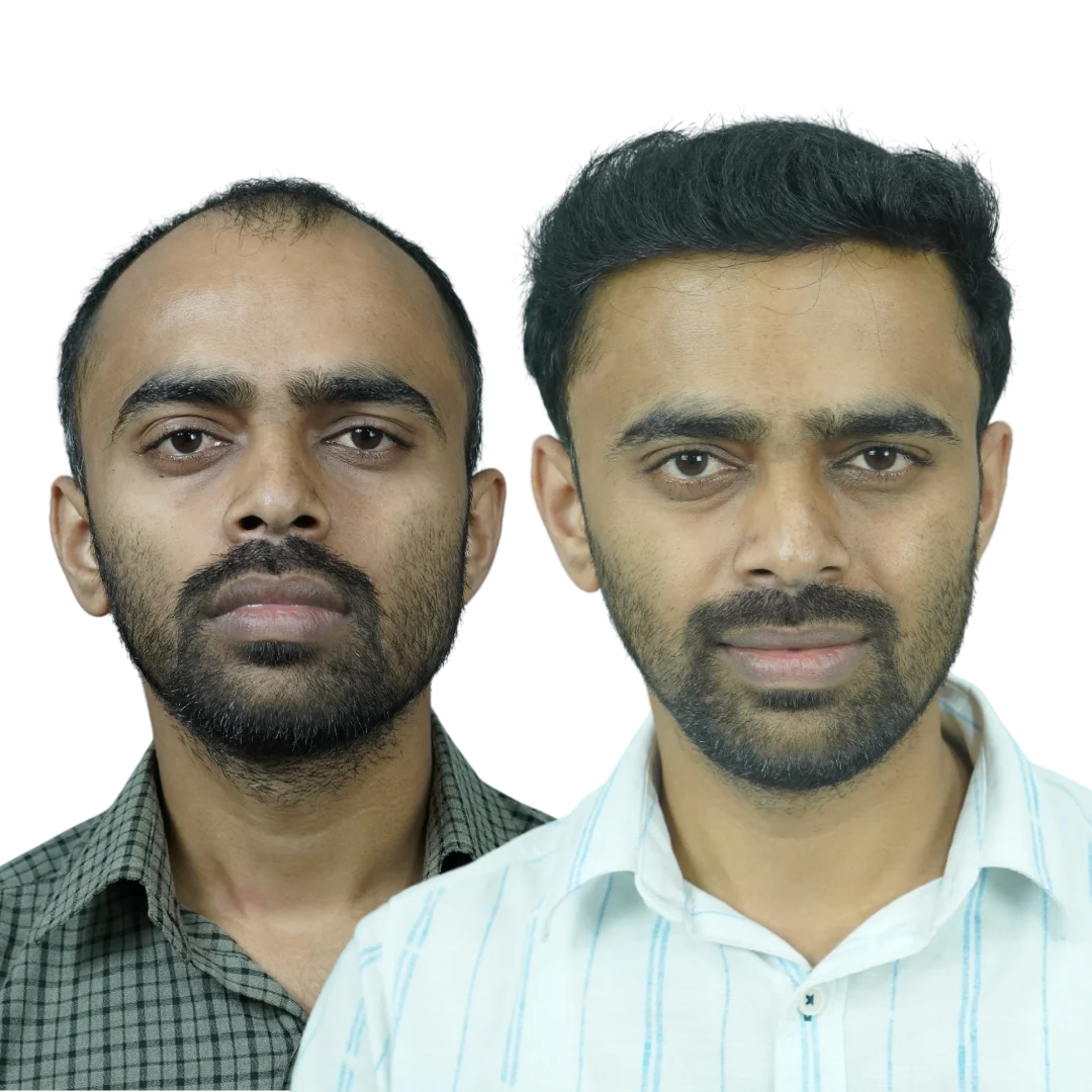 Hair Transplant Result in Pune- Dr Kiran Chotaliya
