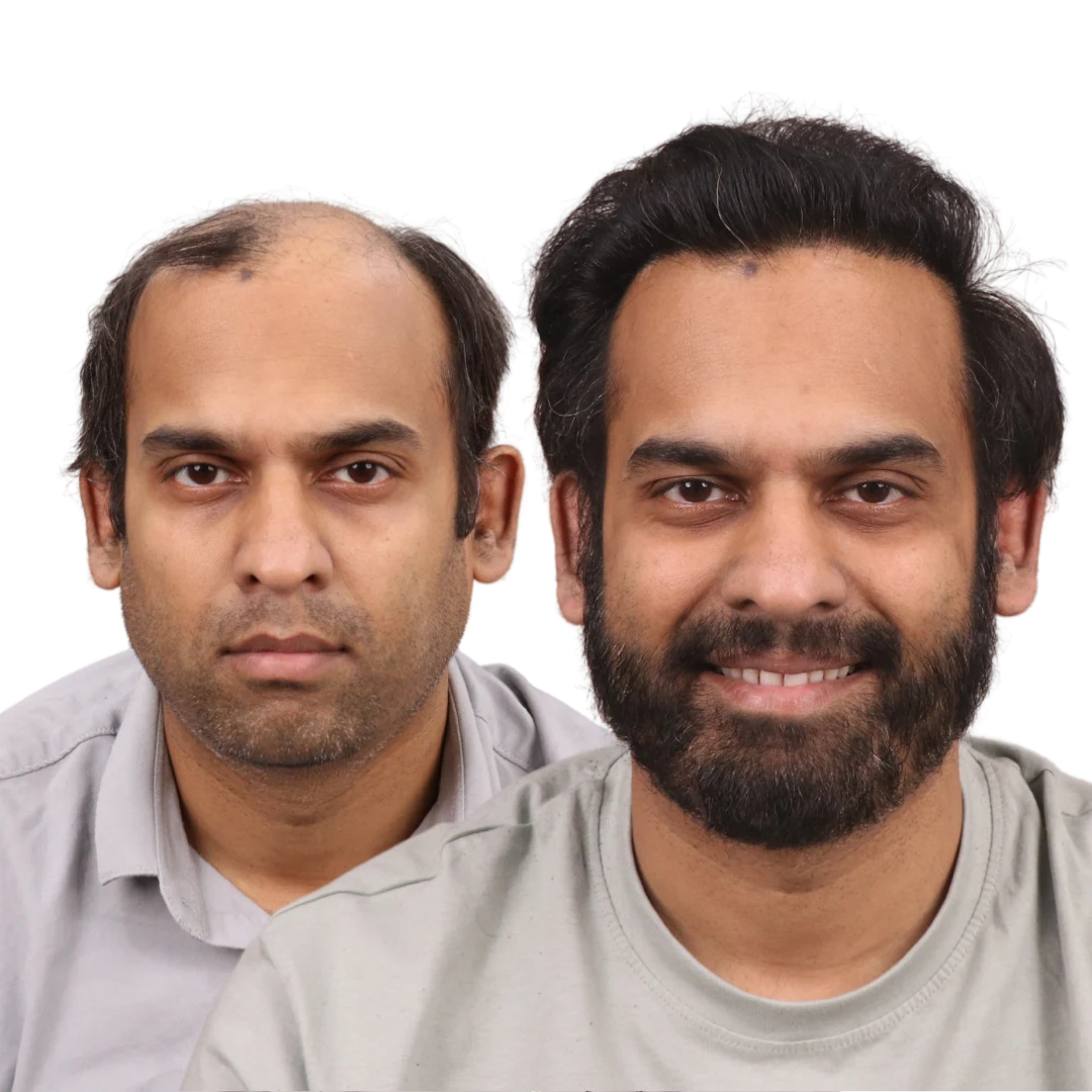Hair Transplant Result in Pune at Pimple Gurav by Dr Kiran Chotaliya