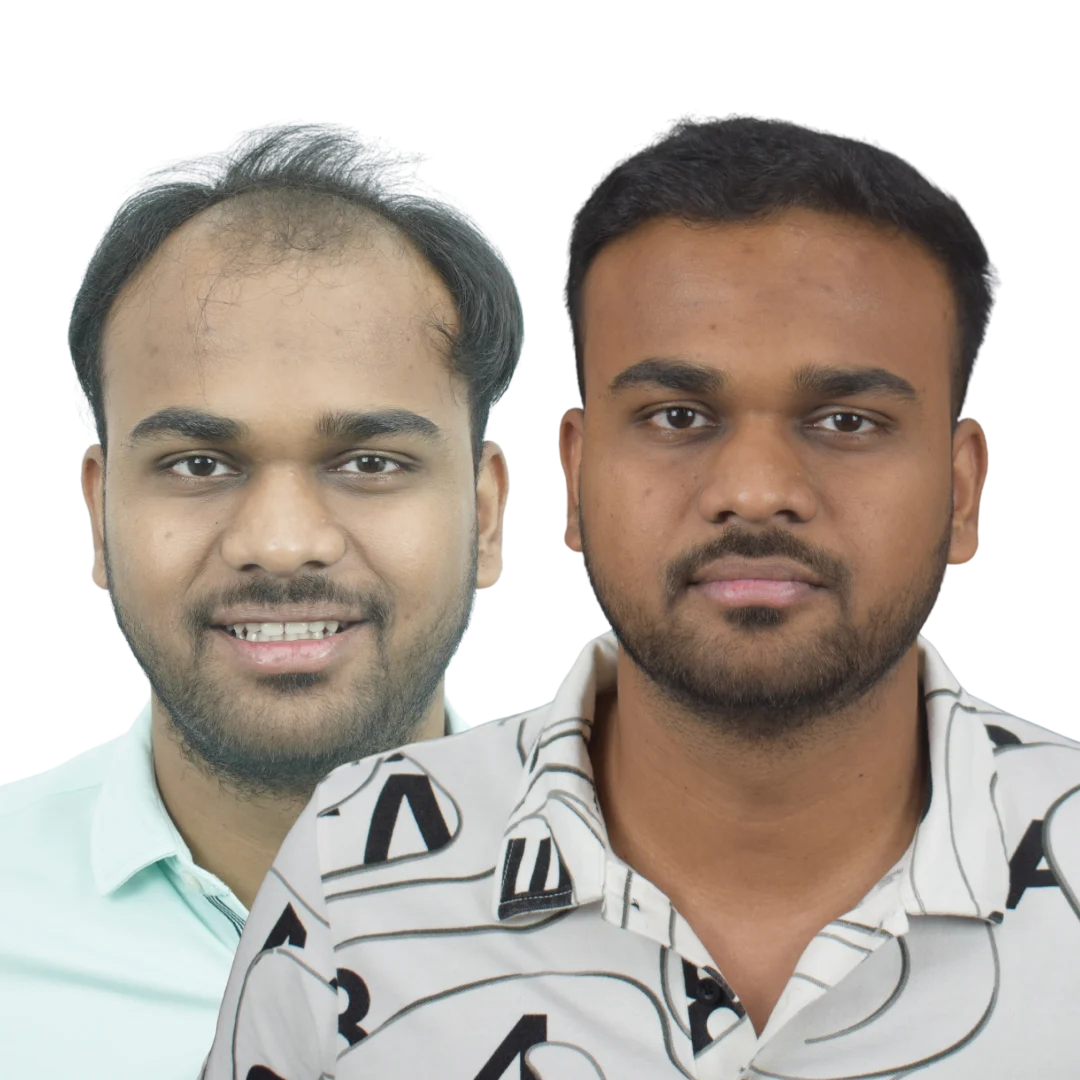 Hair Transplant Result in Pune by Dr Kiran Chotaliya