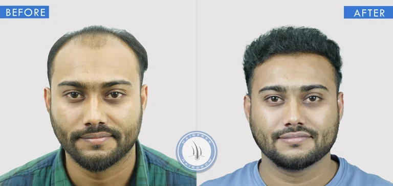 Best Hair Transplant Surgeon in Pune showing before and after hair transplant results for severe hair loss
