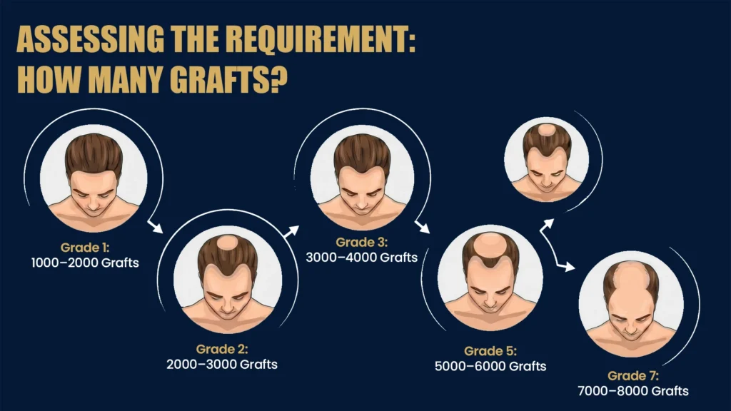 Hair transplant graft requirement chart showing different stages of hair loss and estimated grafts needed in Pune