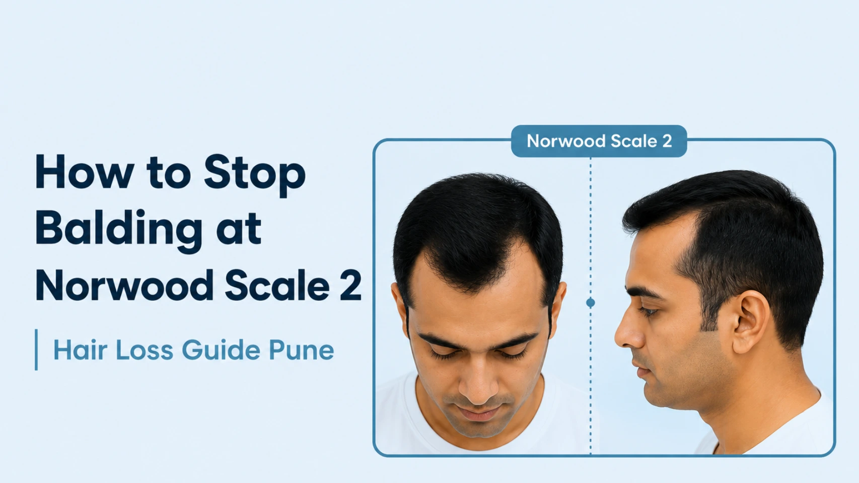 How to Stop Balding at Norwood Scale 2 – Early Hair Loss Guide Pune Showing Receding Hairline
