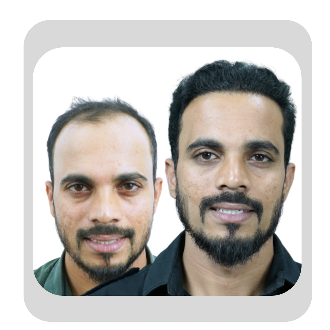 Male Hair Transplant Result in Pune - Dr Kiran Chotaliya's Clinic Pimple Gurav...