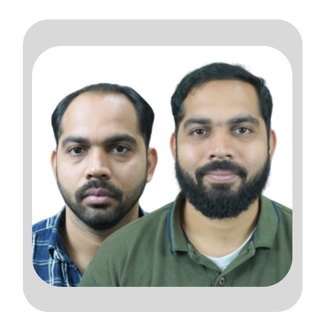Male Hair Transplant Result in Pune - Dr Kiran Chotaliya's Clinic Pimple Gurav.