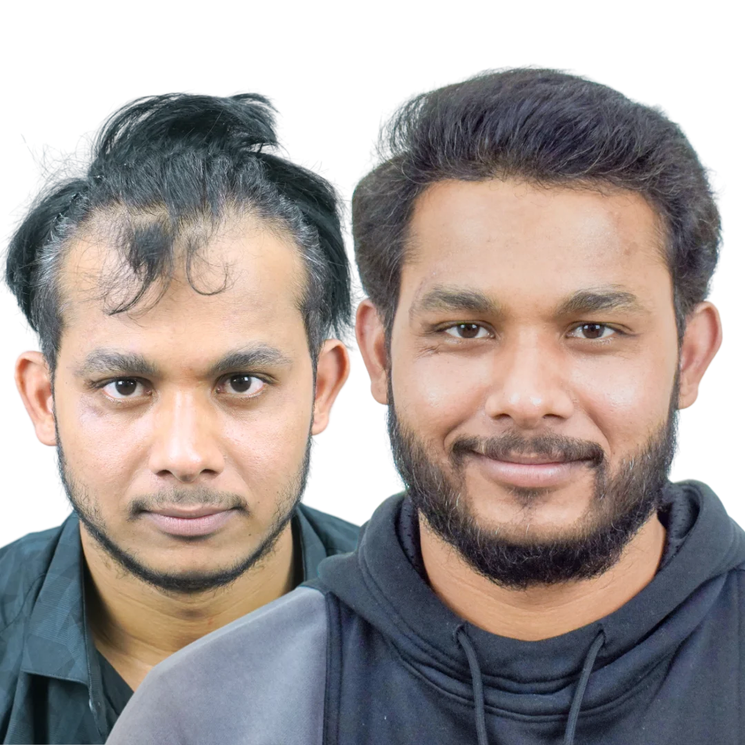 Male Hair Transplant Result in Pune by dr Kiran Chotaliya