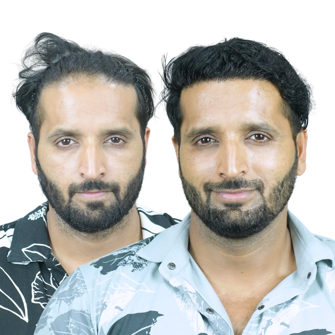 Male Hair Transplant Result in Pune