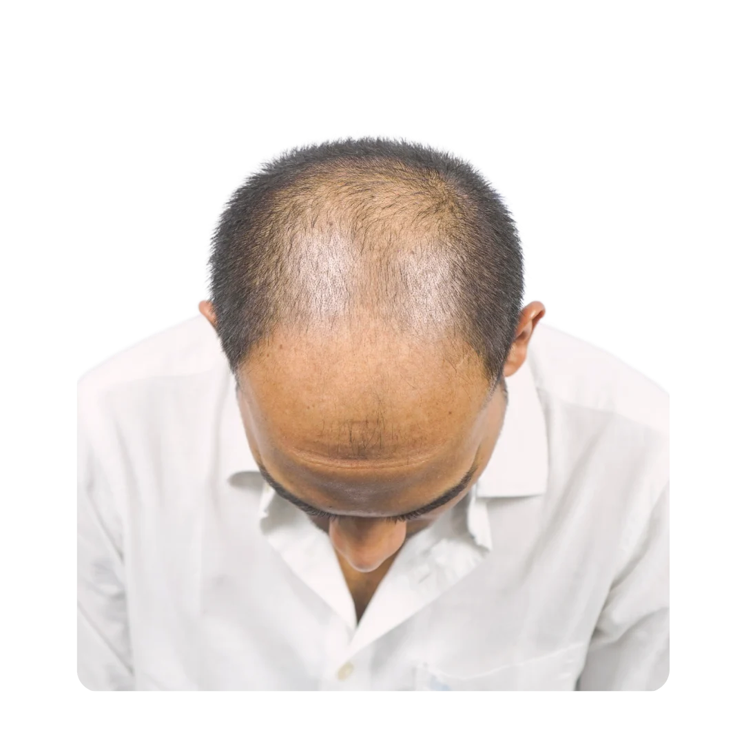 Male pattern baldness vertex view. Ideal candidate for vertex hair transplant in Pune showing advanced thinning.