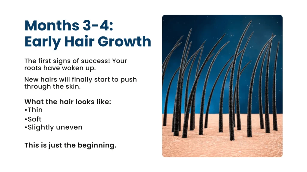 Month 3 to 4 early hair growth after hair transplant surgery