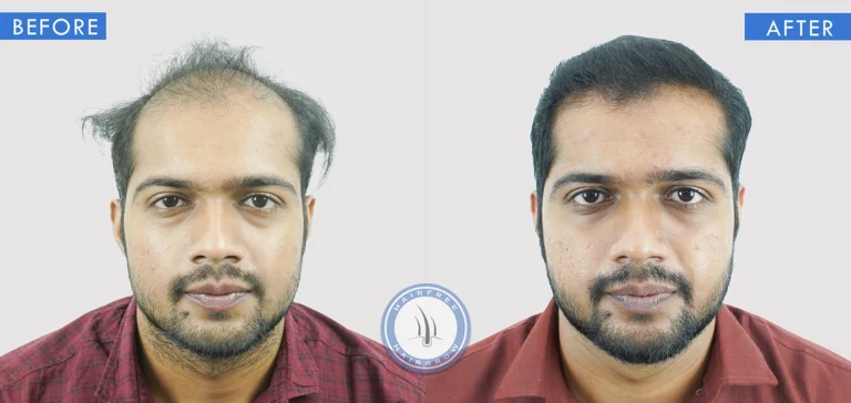 Natural hairline restoration before and after hair transplant treatment in Pune