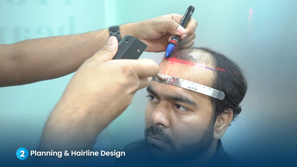 Step 2: Hairline Design and Planning - Dr. Kiran Chotaliya Clinic