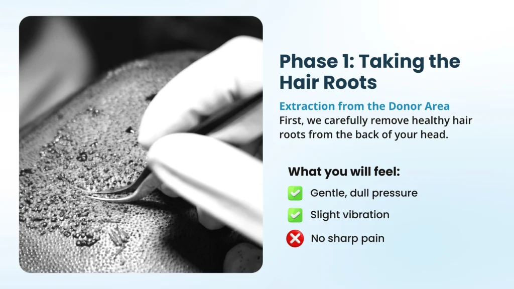 Donor Area Extraction During Hair Transplant in Pune Using Advanced FUE Technique