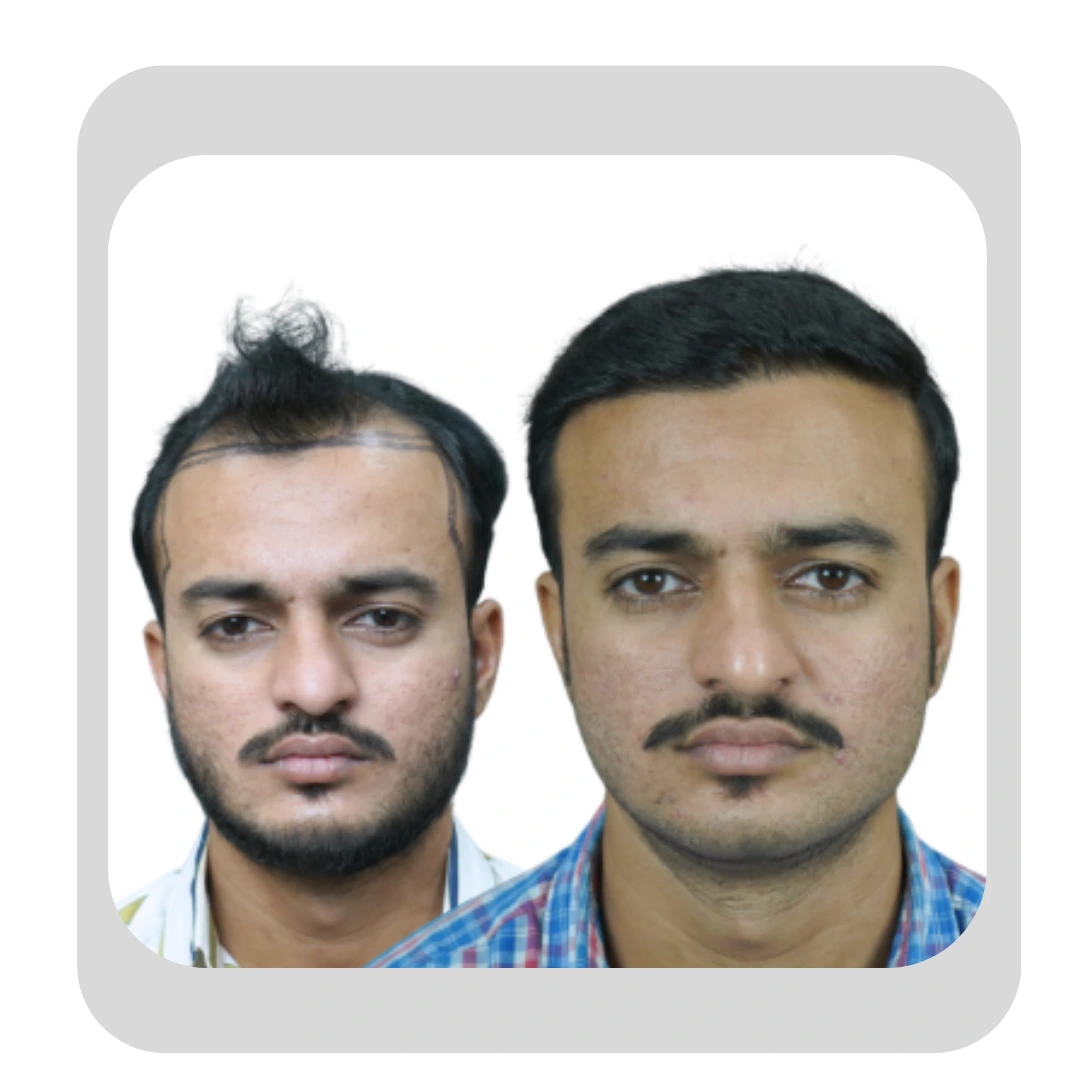 Enhanced facial framing through Hairline Reconstruction