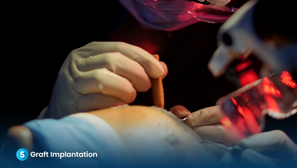 Step 5: Graft Implantation - Dr. Kiran Chotaliya Clinic