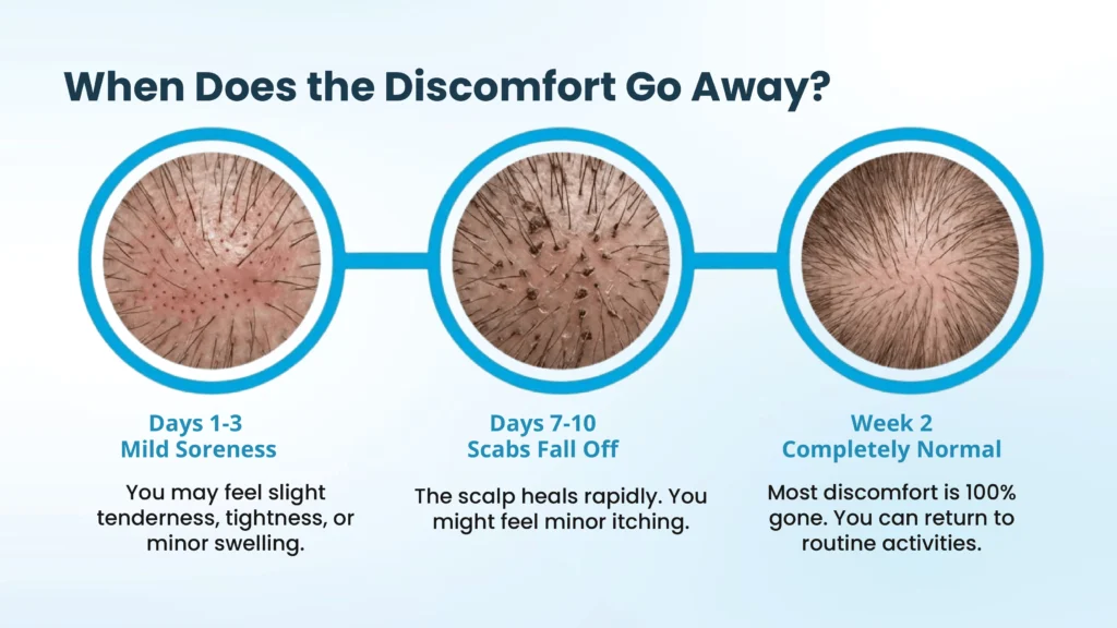 Hair Transplant Recovery Timeline in Pune Showing When Discomfort Completely Subsides After Treatment