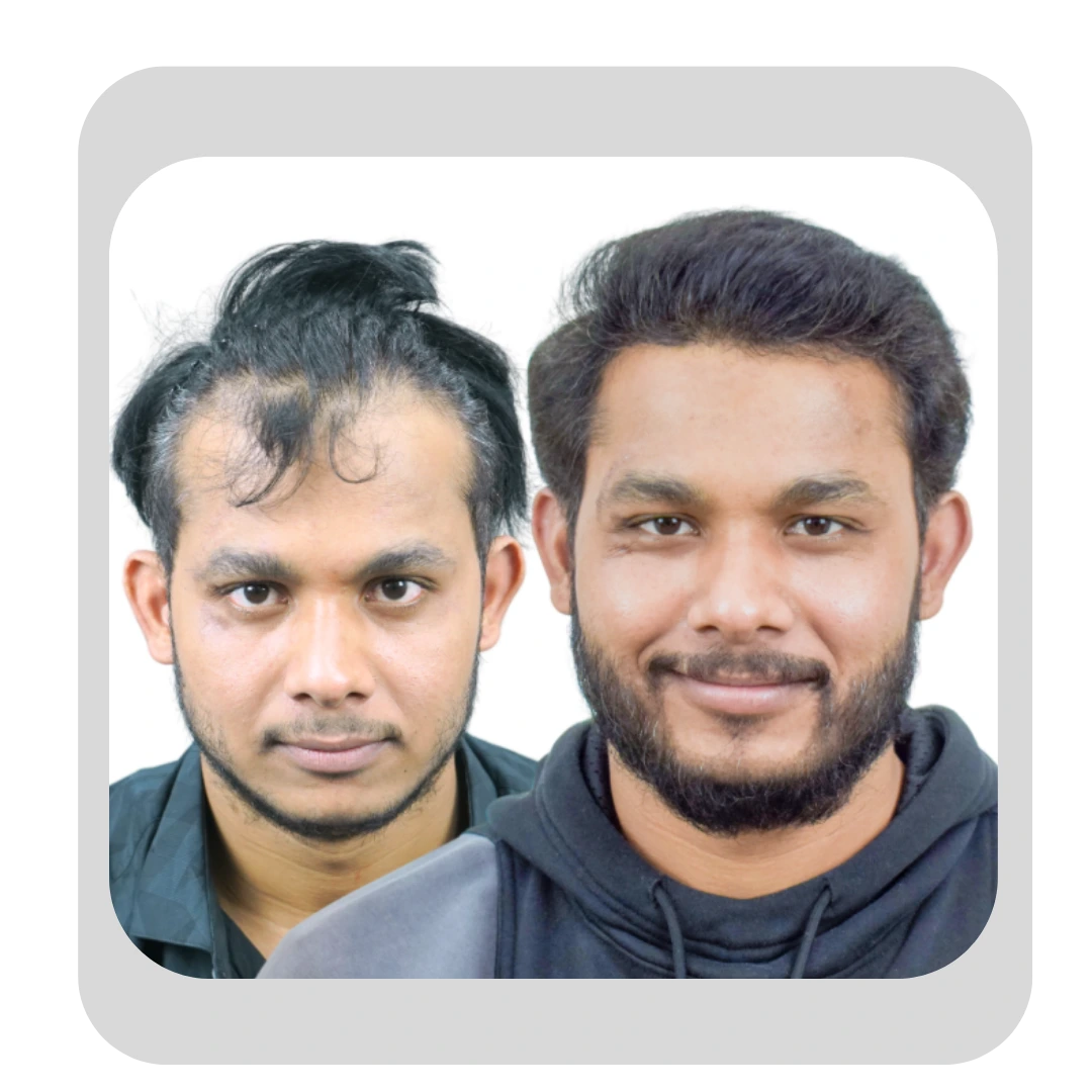 Hairline Reconstruction in Pune Before and After Patient Transformation