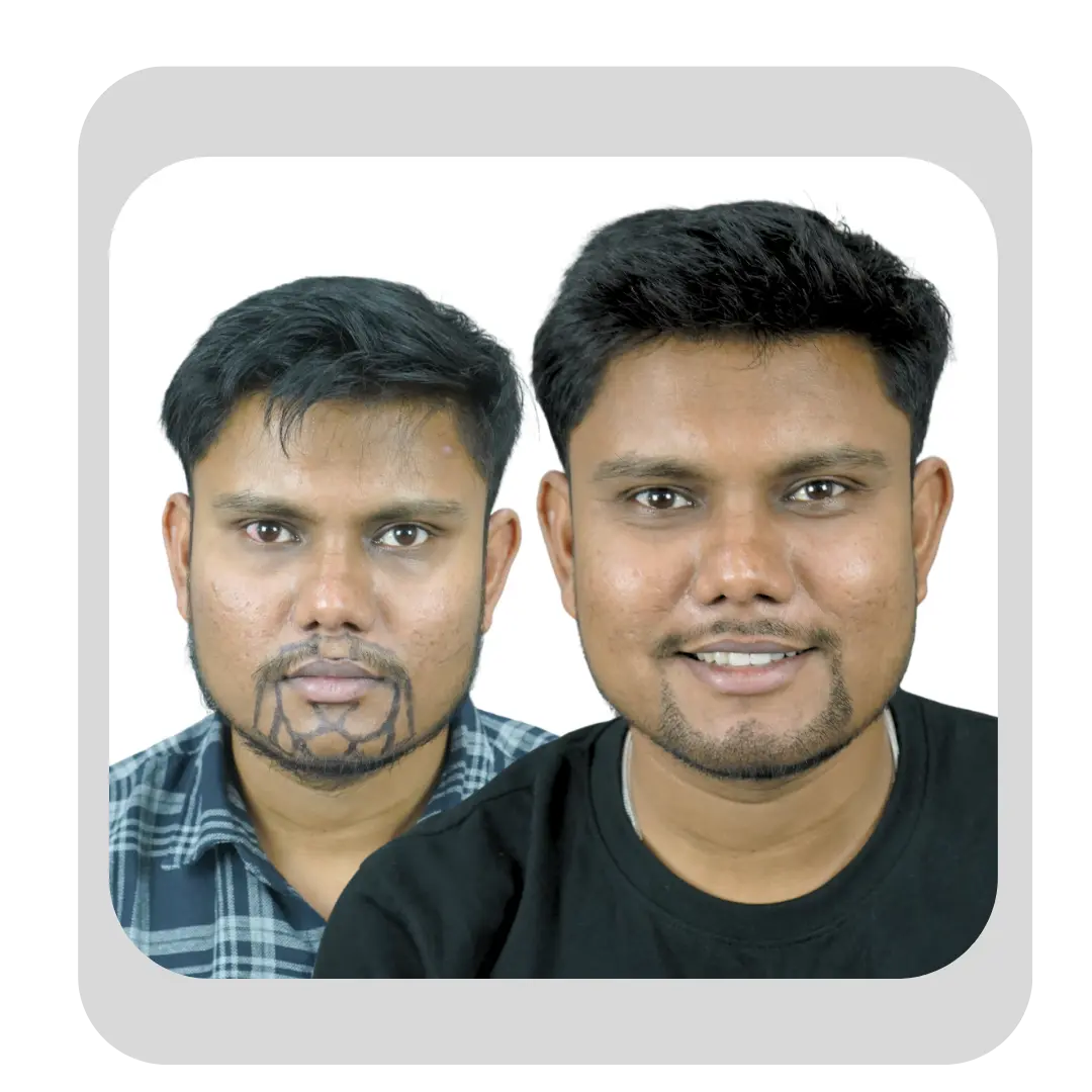 Successful beard and moustache transplant before and after result in Pune