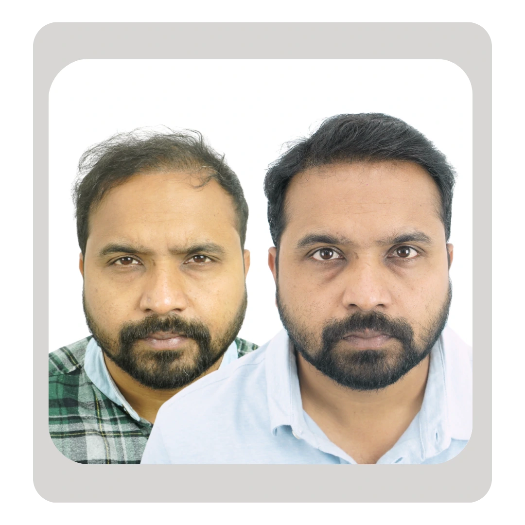 Corrective hair transplant procedure restoring a natural hairline after an unsuccessful hair transplant