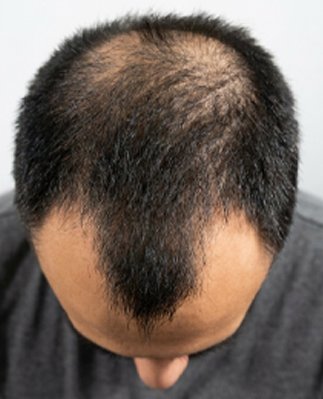 Androgenetic Alopecia Hair Loss Condition Treated with PRP Therapy in Pune