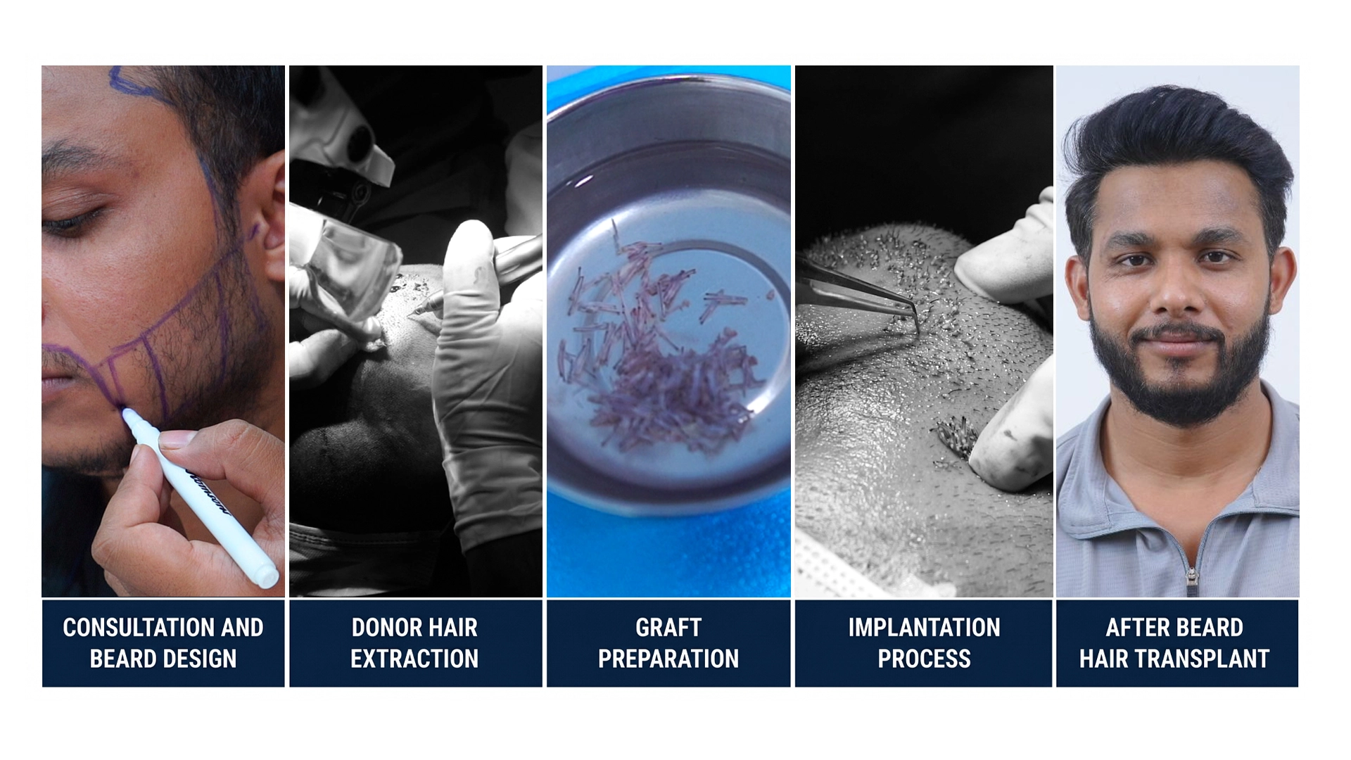 Beard hair transplant procedure showing consultation and beard design, donor hair extraction, graft preparation, implantation process, and final beard transplant results.