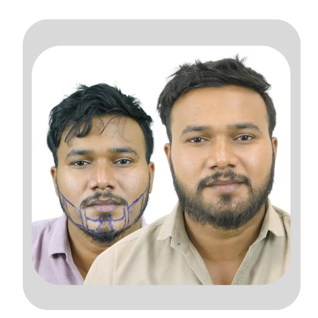 Dense beard and moustache transplant before and after by Dr. Kiran Chotaliya
