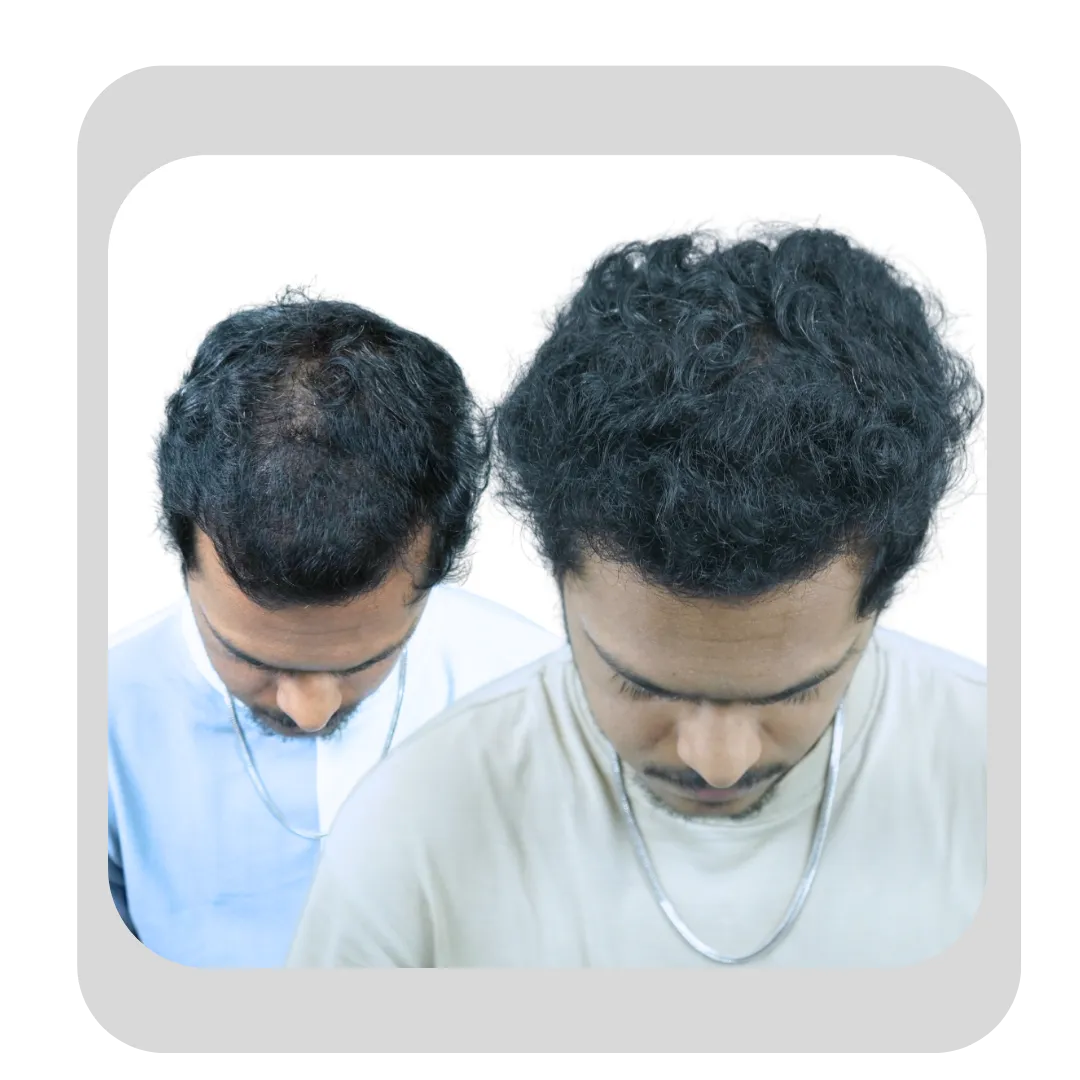 Hair mesotherapy treatment results before and after for pattern hair loss