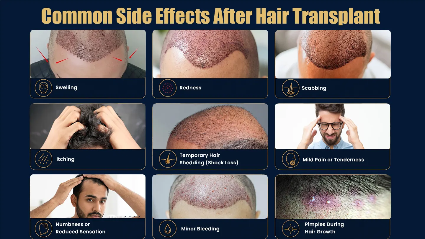 Common side effects after hair transplant including redness, swelling, and scabbing during recovery