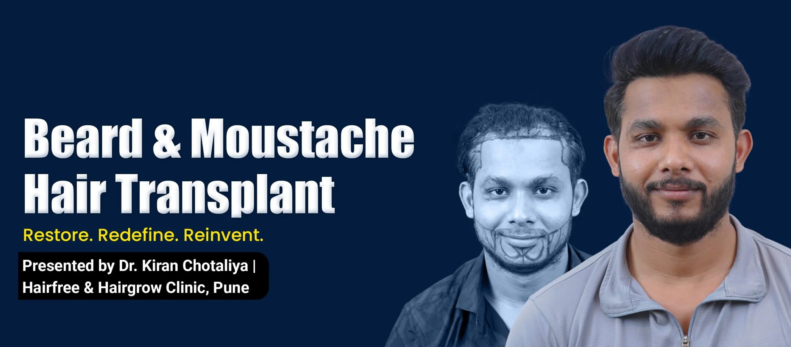 Beard & Moustache Hair Transplant Guide by Dr. Kiran Chotaliya Showing Natural Facial Hair Restoration