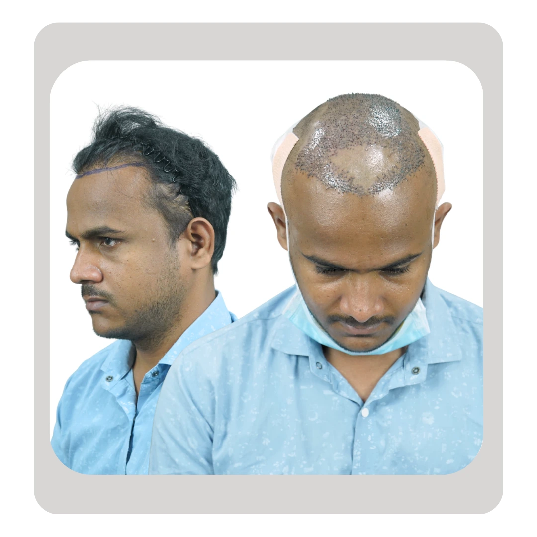 Failed hair transplant correction with improved hairline reconstruction and graft repair by Dr. Kiran Chotaliya