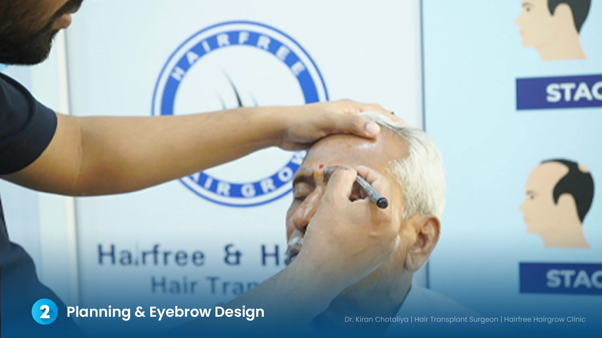 Dr. Kiran Chotaliya performing eyebrow design planning before eyebrow hair transplant at Hairfree & Hairgrow Clinic, Pimple Gurav, Pune