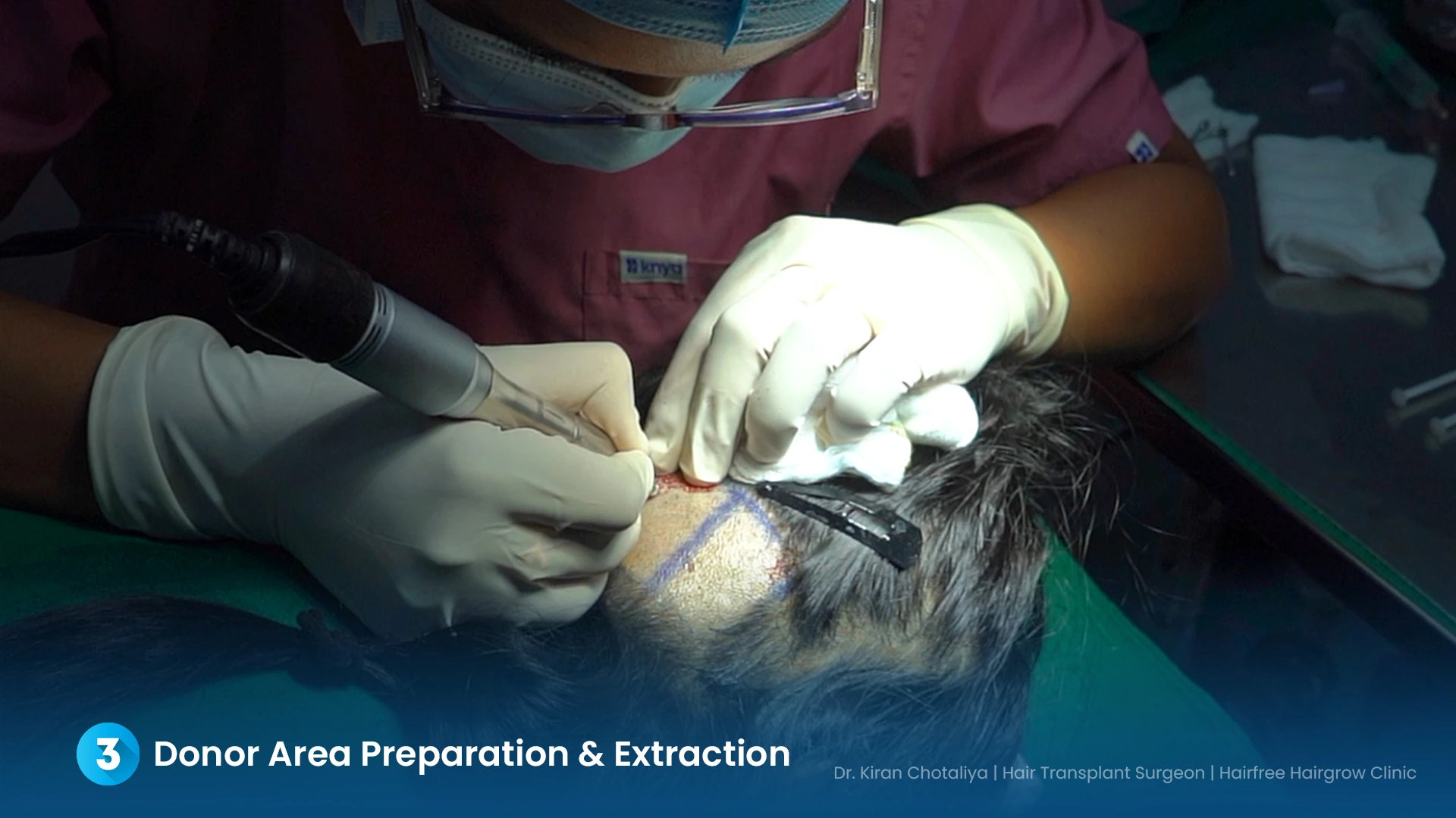 Dr. Kiran Chotaliya performing FUE donor graft extraction for eyebrow hair transplant at Hairfree & Hairgrow Clinic, Pimple Gurav, Pune