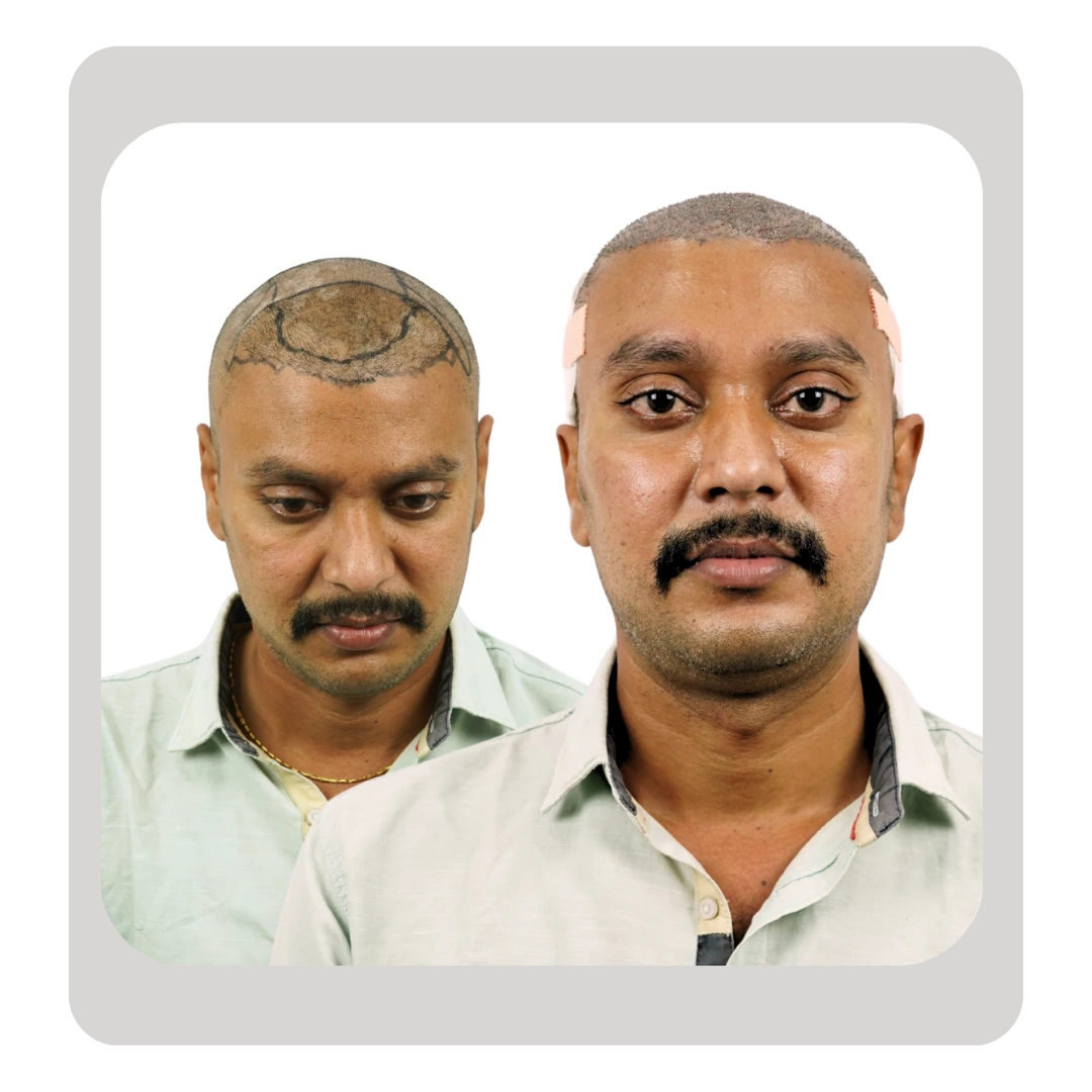 Patient after failed hair transplant repair surgery showing corrected hairline and improved graft placement in Pune