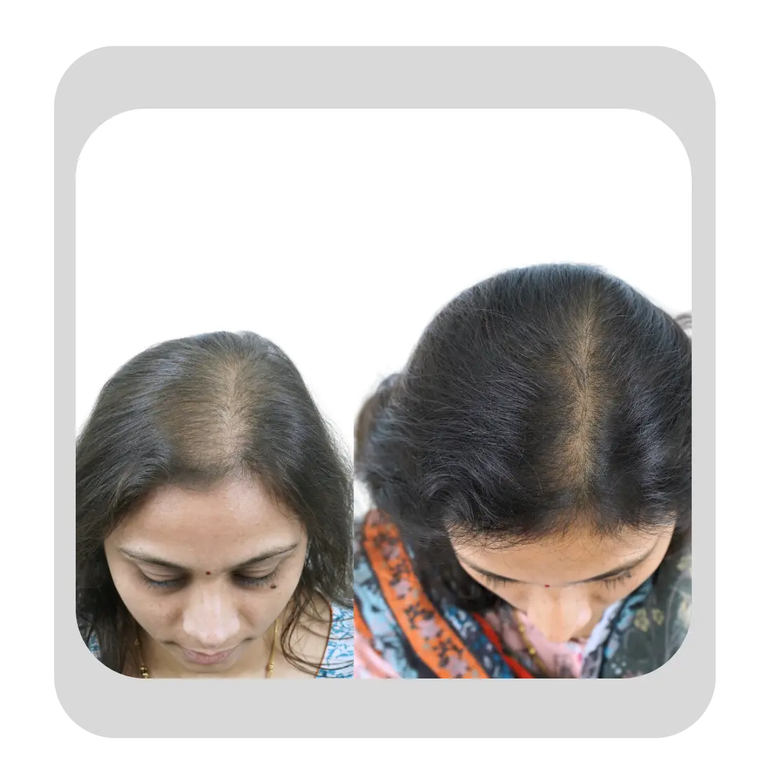 Female GFC hair treatment before and after showing reduced hair thinning and improved scalp coverage in Pune