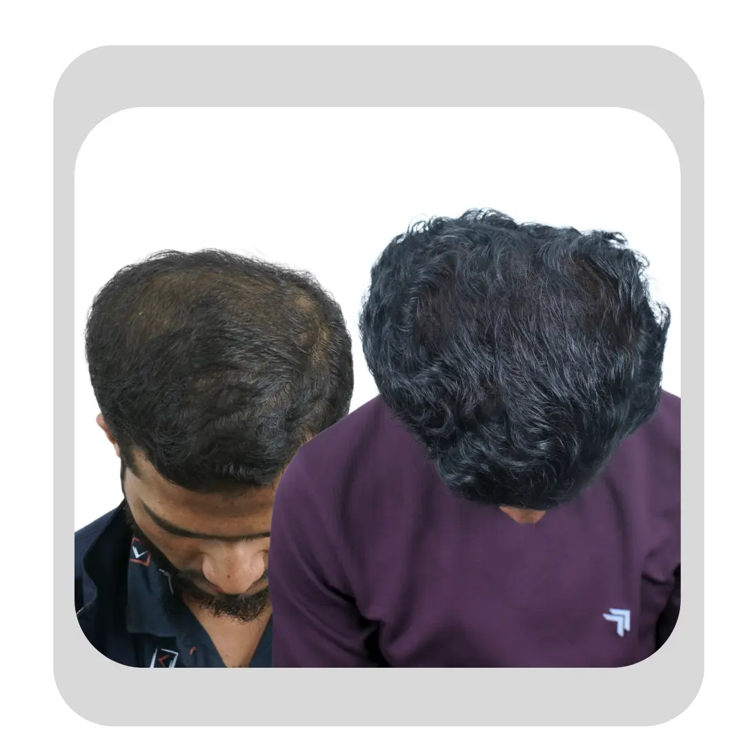 GFC hair regrowth results showing thicker hair and improved crown coverage in a male patient