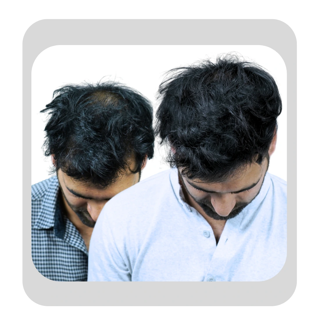 GFC hair restoration before and after showing thicker hair growth and improved density in a male patient