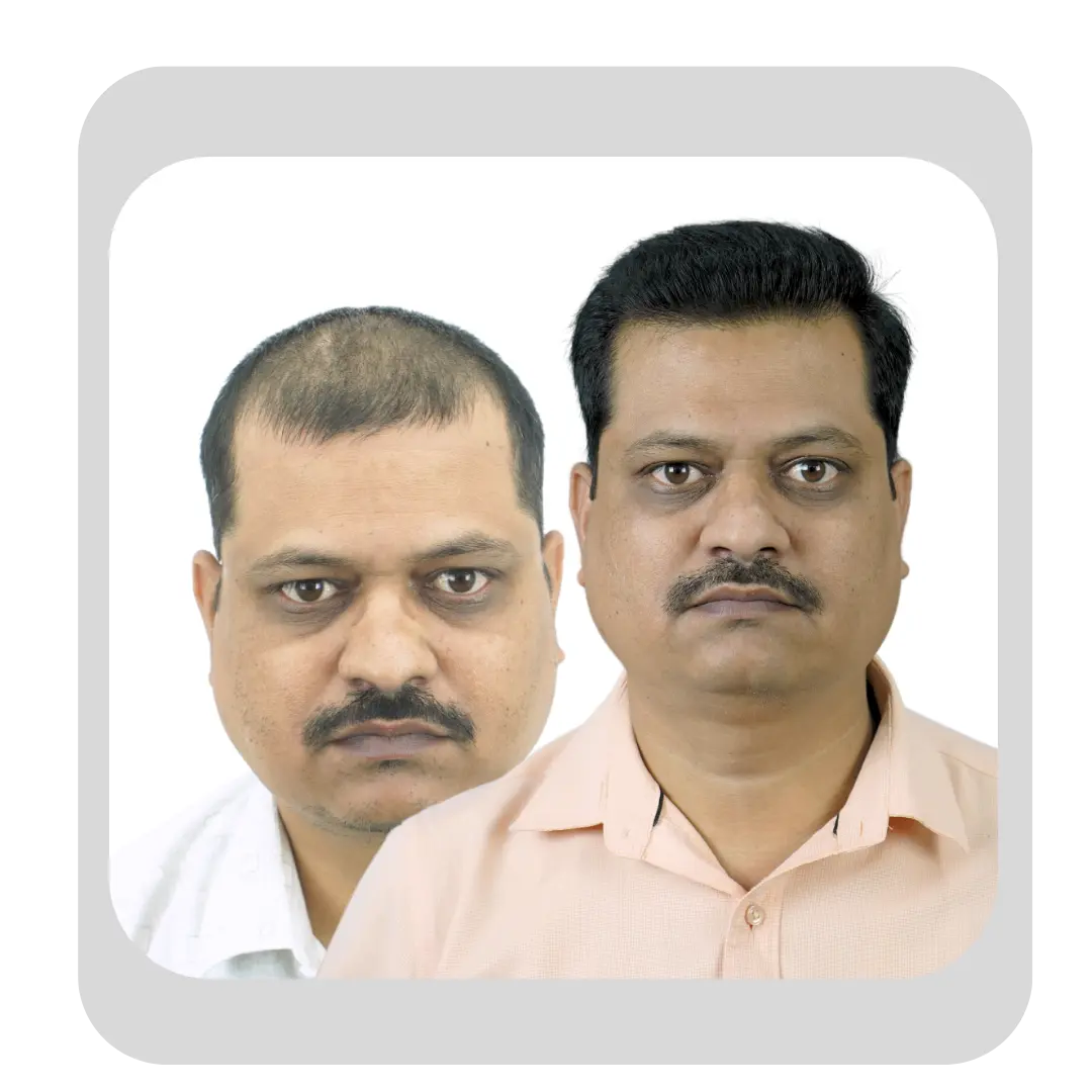 GFC hair treatment before and after results showing improved hair density in a male patient at Hairfree Hairgrow Clinic Pune