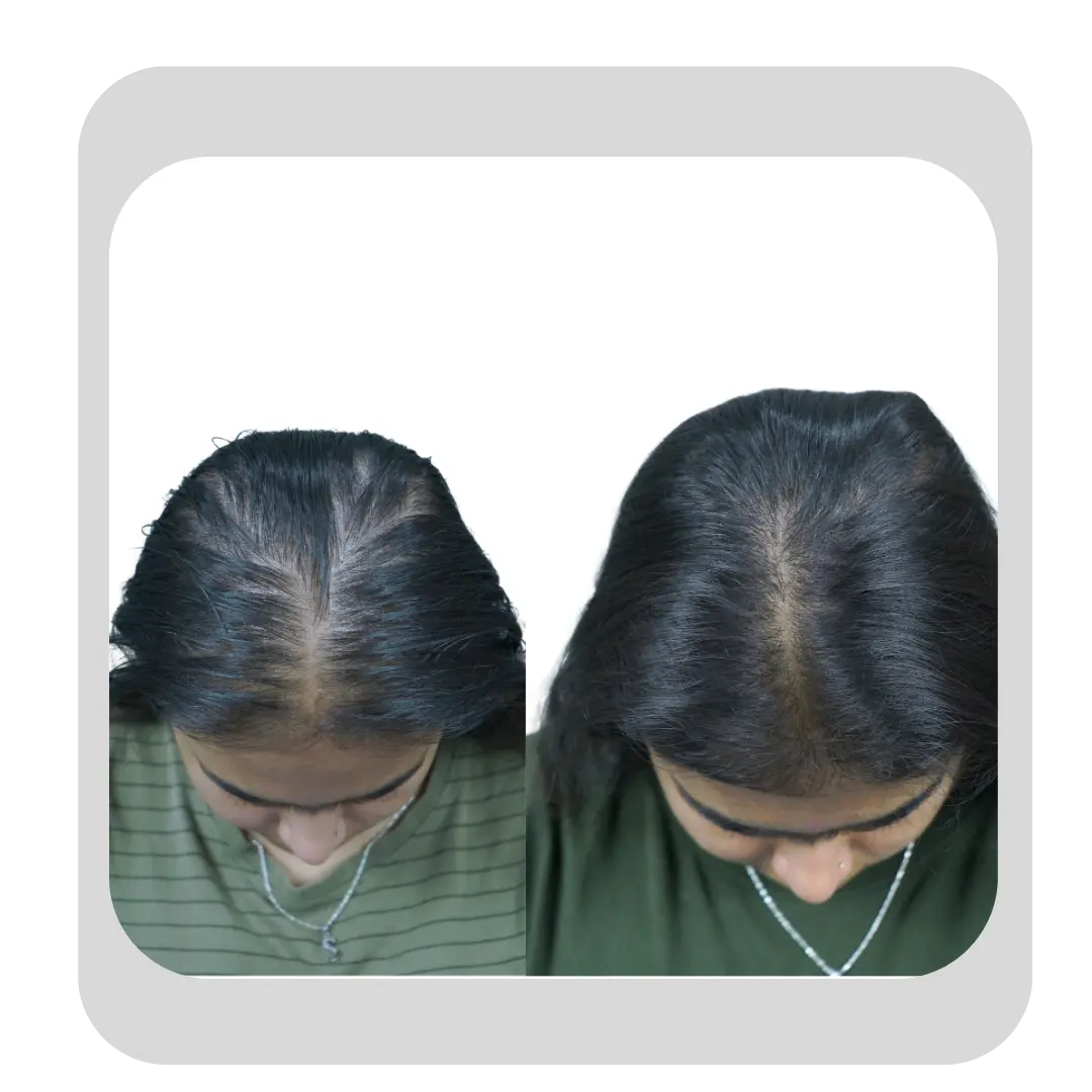 Before and after GFC treatment showing improved scalp coverage in a female with hair thinning