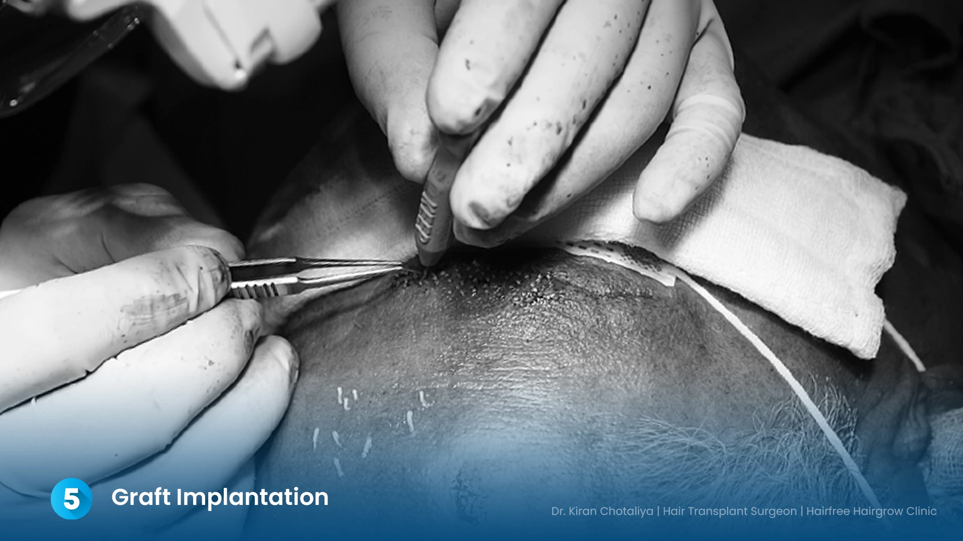 Graft implantation during eyebrow hair transplant by Dr. Kiran Chotaliya at Hairfree & Hairgrow Clinic, Pimple Gurav, Pune