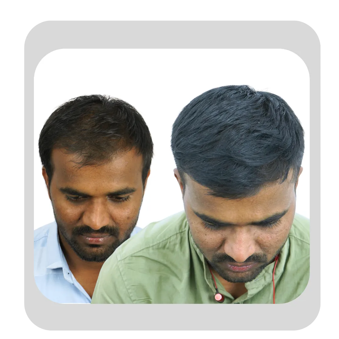 Hair mesotherapy before and after for early-stage hair thinning