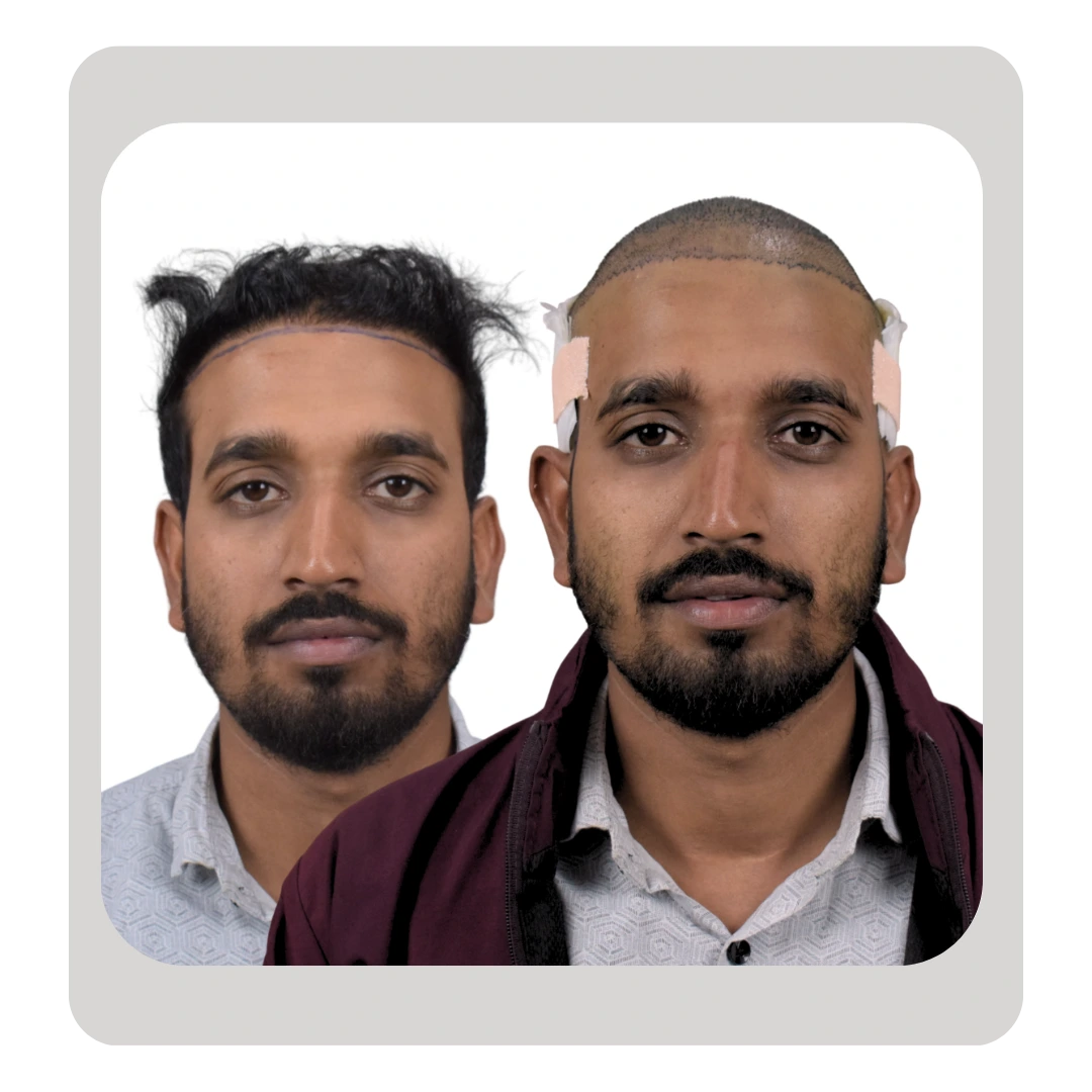 Patient immediately after failed hair transplant repair surgery with newly implanted grafts in Pune