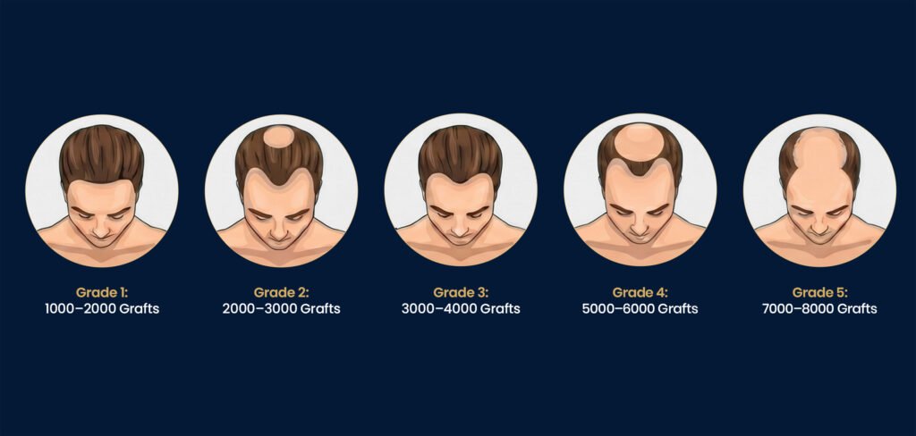 Hair transplant graft requirement chart showing different stages of hair loss and estimated grafts needed in Pune