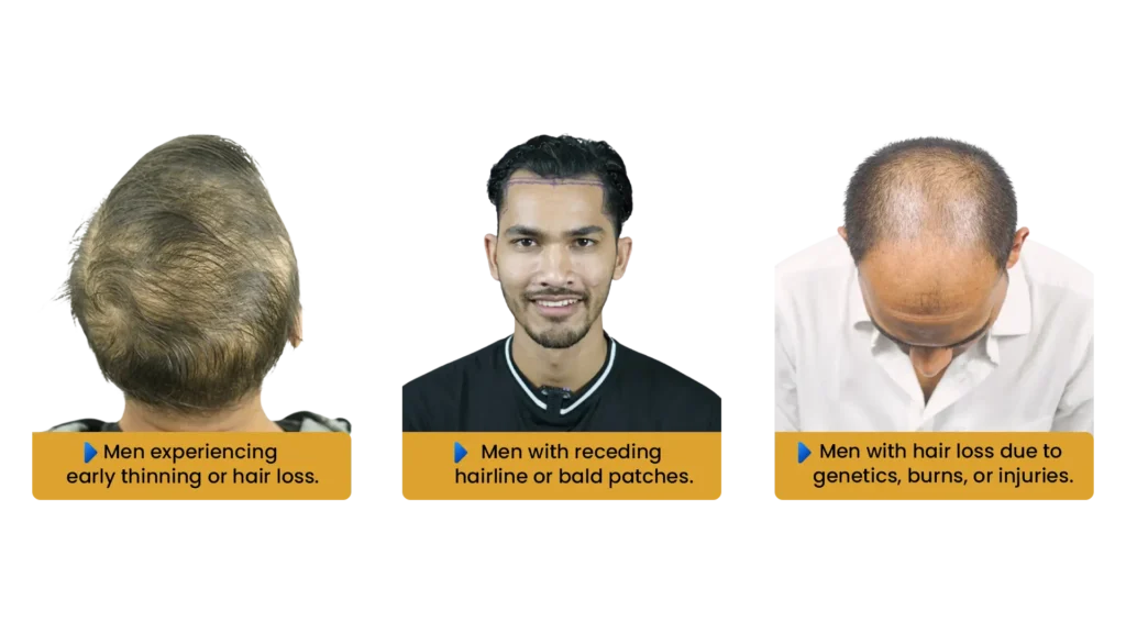 Ideal candidates for hair transplant showing common hair loss conditions in men including thinning crown, receding hairline, and patchy bald areas.