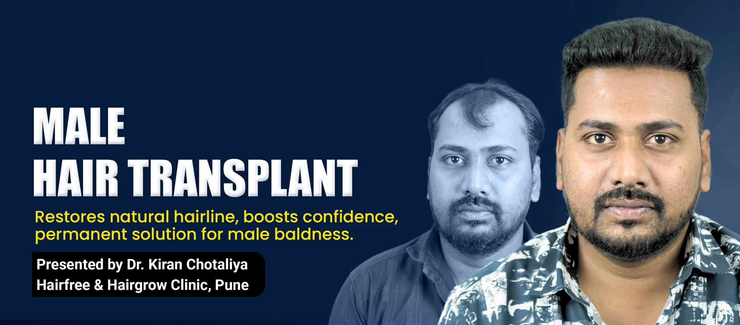 Male hair transplant in Pune, performed by Dr. Kiran Chotaliya, showcases excellent high-density hair restoration.