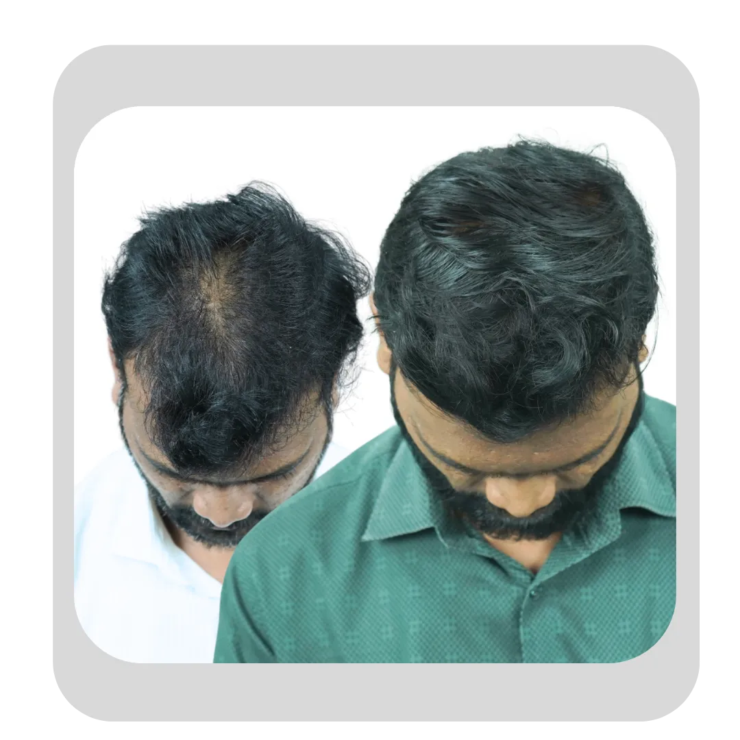 Before and after results of hair mesotherapy showing improved hair density