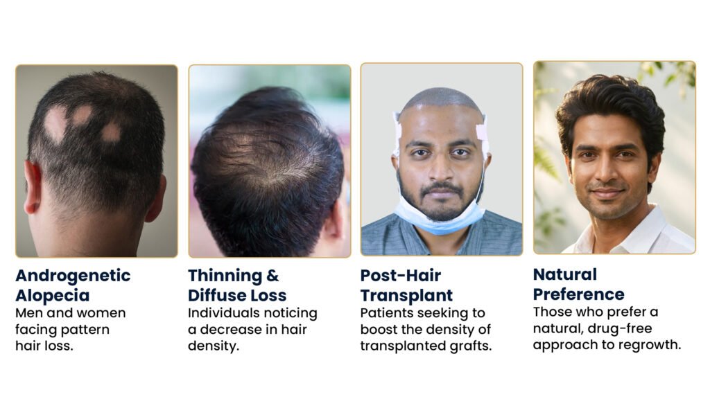 Microneedling for Hair Loss in Pune – Ideal candidates including androgenetic alopecia, diffuse hair thinning, post-hair transplant patients, and individuals seeking natural hair restoration