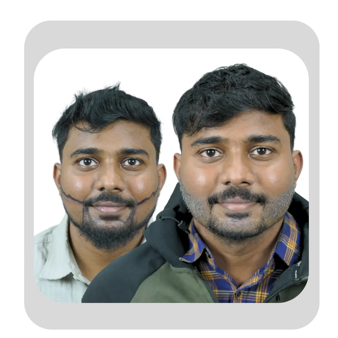 Natural beard and moustache hair transplant transformation in Pune