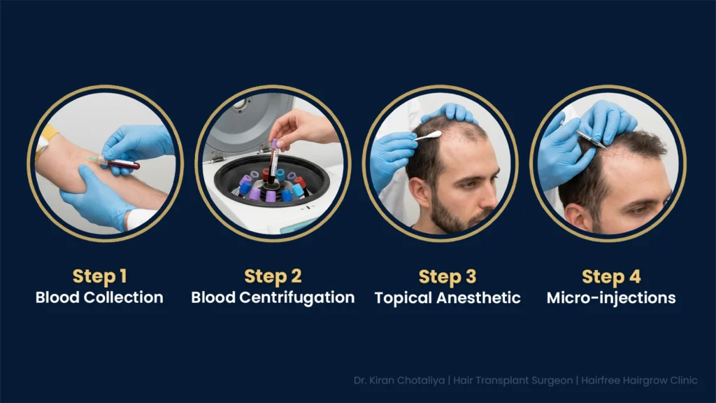 PRP Treatment Procedure for Hair Loss in Pune Showing Blood Collection, Centrifugation, Anesthetic Application and Scalp Injections