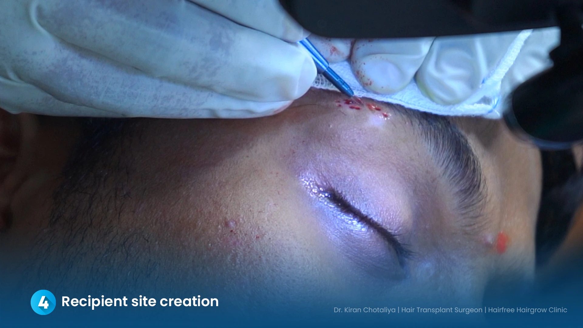 Dr. Kiran Chotaliya creating recipient sites for eyebrow hair transplant at Hairfree & Hairgrow Clinic, Pimple Gurav, Pune